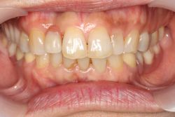 女性 中間欠損 MTC