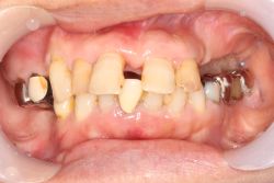 ６０代 女性
中間欠損 MTC