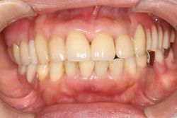 ６０代 女性 中間欠損 MTC