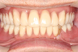 男性総義歯 MTC