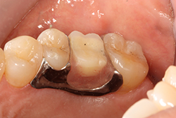 ３０代 女性中間欠損（１・２本） MTC