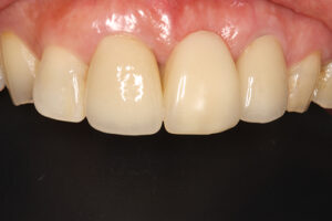 女性中間欠損（１・２本） MTC