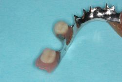 人工歯交換/作業後