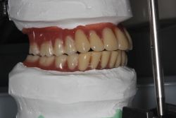 人工歯移動/作業前