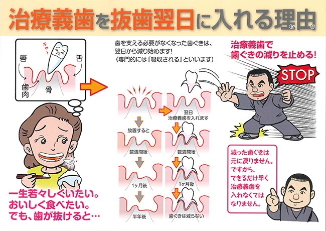 治療義歯を抜歯よく実に入れる理由