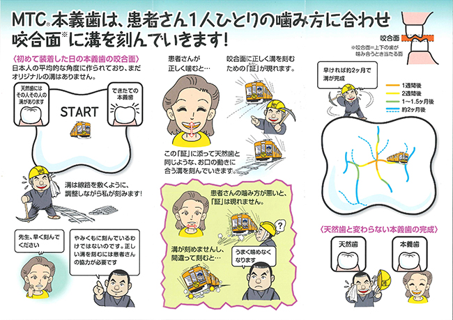 本義歯の製作プロセスを示すイラスト